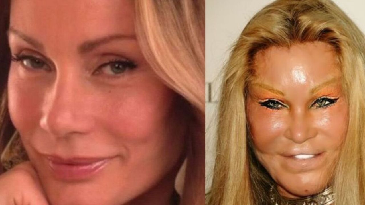 Cat Woman before and after plastic surgery.
