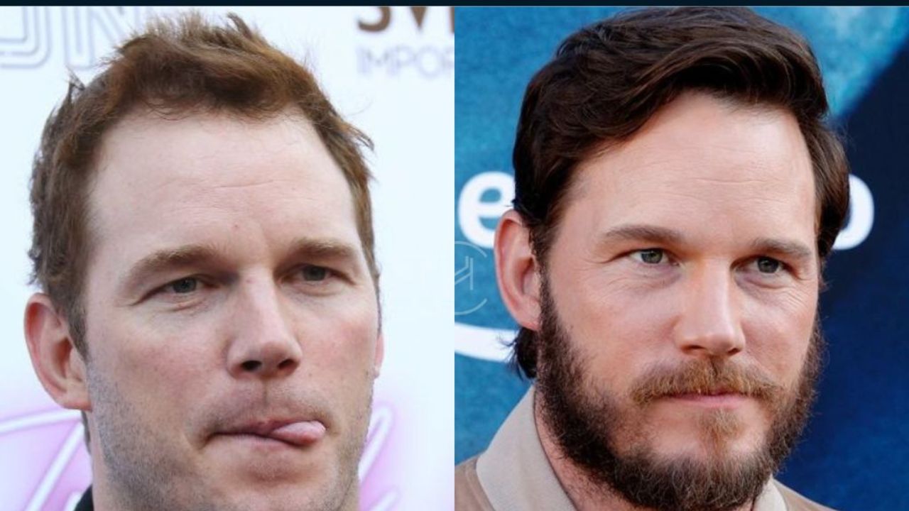 Chriss Pratt after a hair transplant.