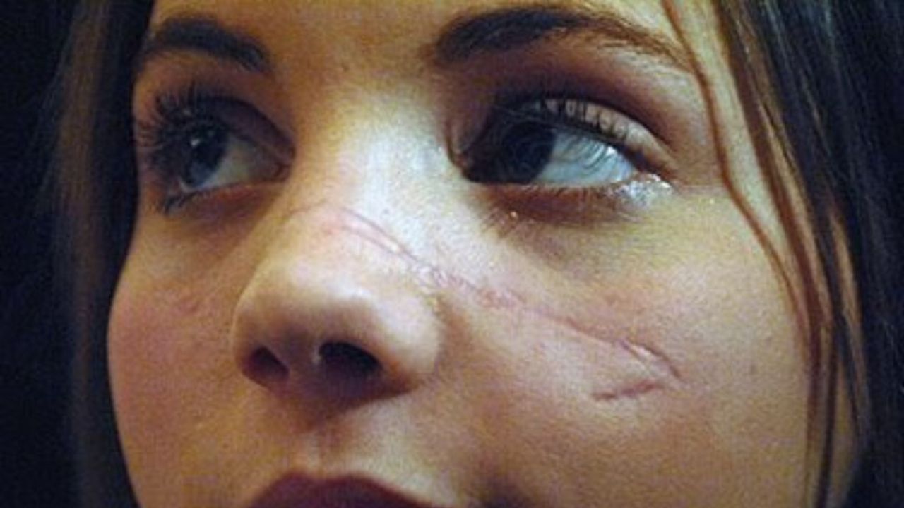 Jessica Dube’s Scar: How Is It Now? Face Injury & 2023 Update! blurred-reality.com