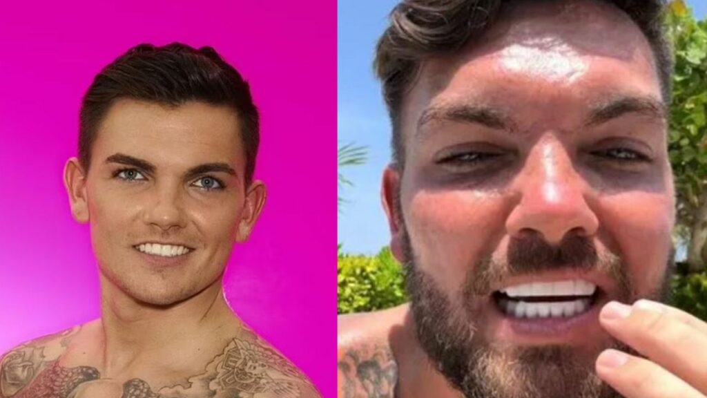 Sam Gowland’s New Turkey Teeth: Before and After Pictures Examined! blurred-reality.com