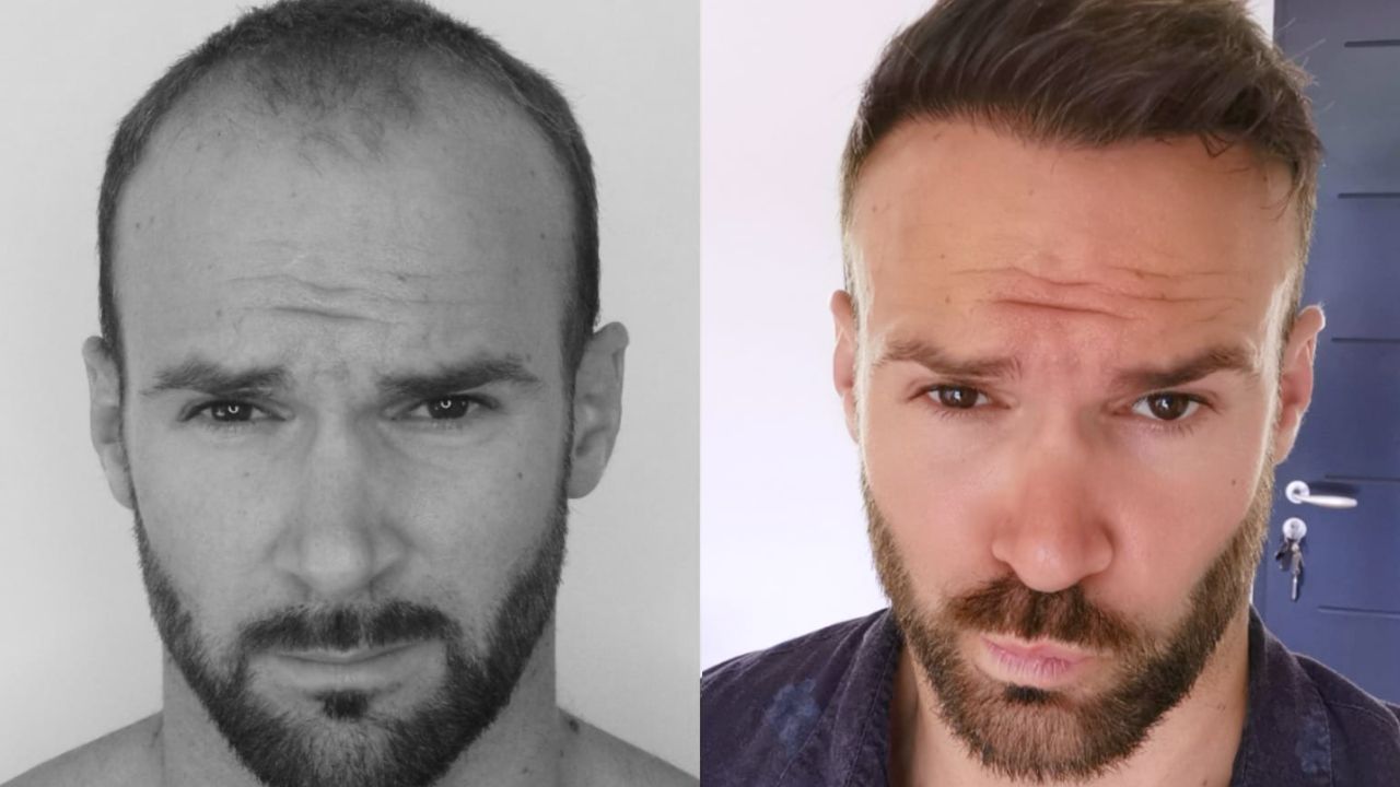 It might take months to see the result after a hair transplant. blurred-reality.com